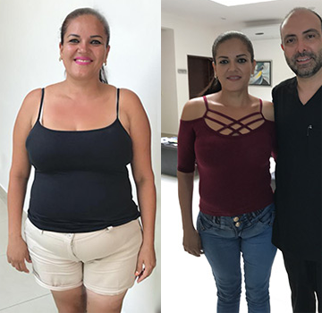testimonios reales de personas con cirugia para bajar de peso